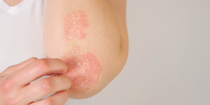 The Role of Prebiotics in Managing Eczema and Other Skin Conditions