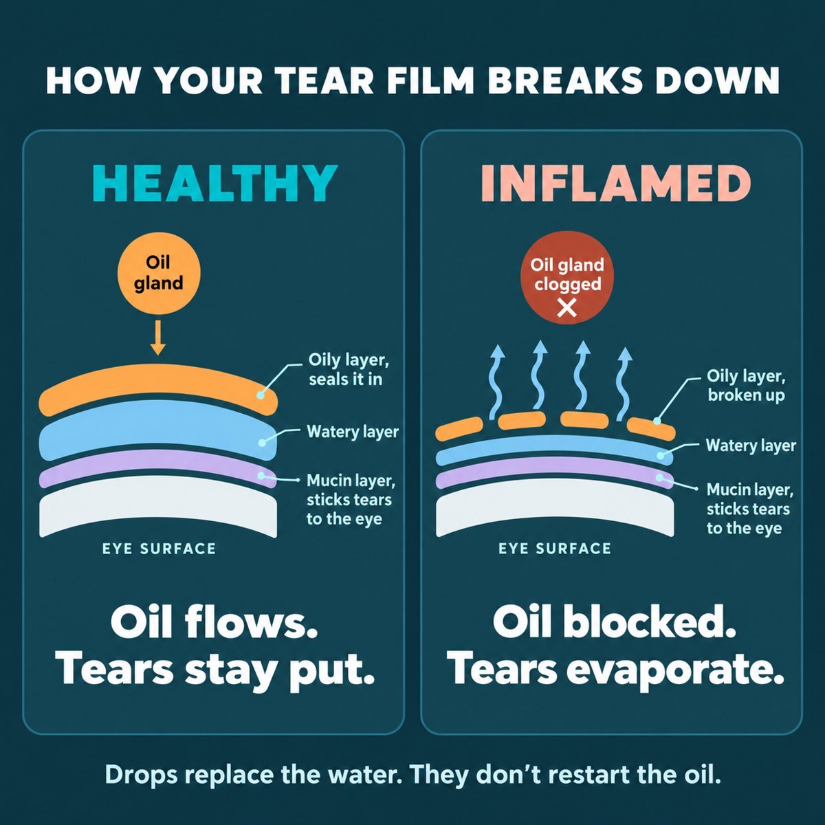 How the tear film breaks down when the oil glands are inflamed